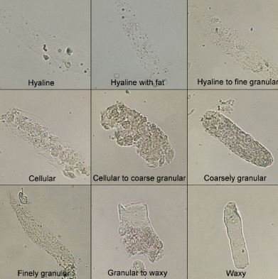 10+ Hyaline Casts Secrets For Better Health