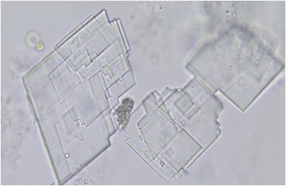 Cholesterol Crystals In Urine