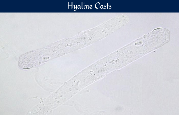 Urinary Hyaline Casts Explained Causes Uncovered