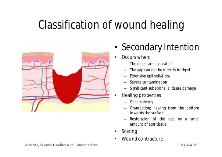 What Is Tertiary Intention Wound? Healing Guide